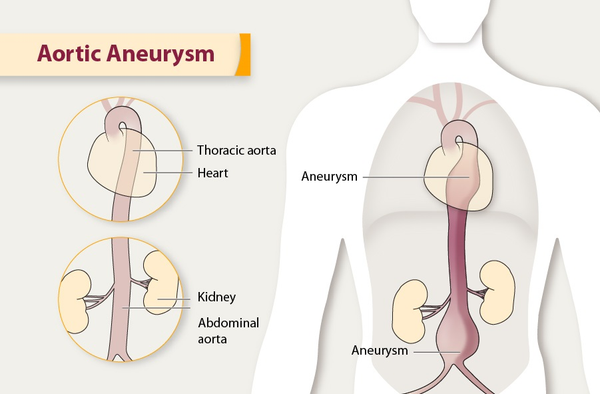 All That You Need To Know About Aortic Aneurysm