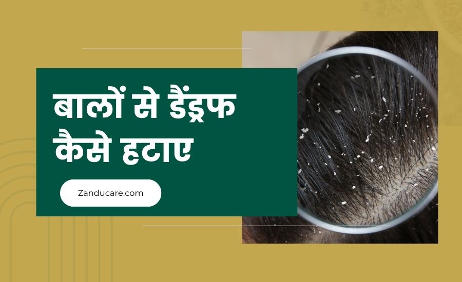 remove dandruff from hair